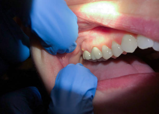 Best Knocked-Out Tooth (Avulsed Tooth) Treatment in Rainbow Lakes, NJ